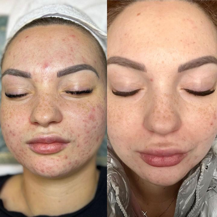 I know what a bouncy skin means now. Thanks to Beyond Miracles