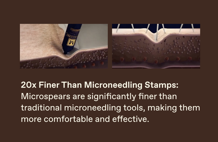 Microneedling vs. Microspear® Technology: What’s the Real Difference?