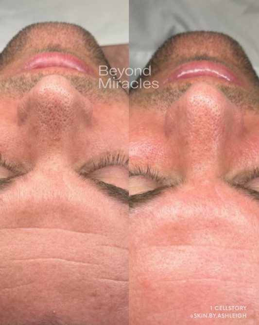 Minimized Pores, Smoother Skin