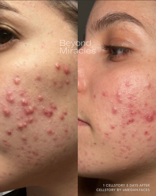 Clearer Skin in Just Days 3 Days!